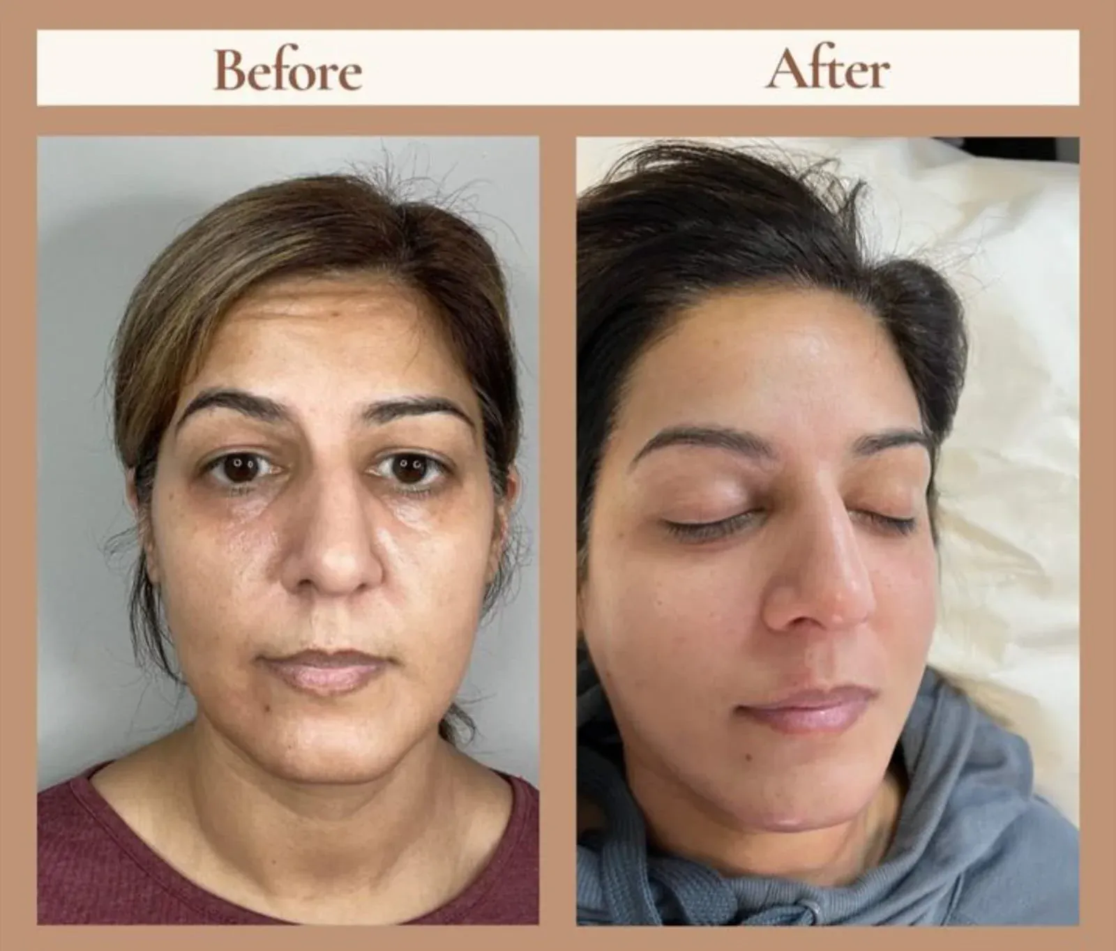 PRP vampire facial before and after results