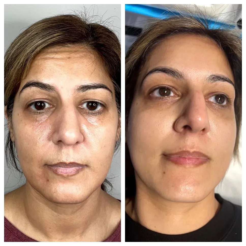 PRP microneedling results at Northern New Jersey med spa