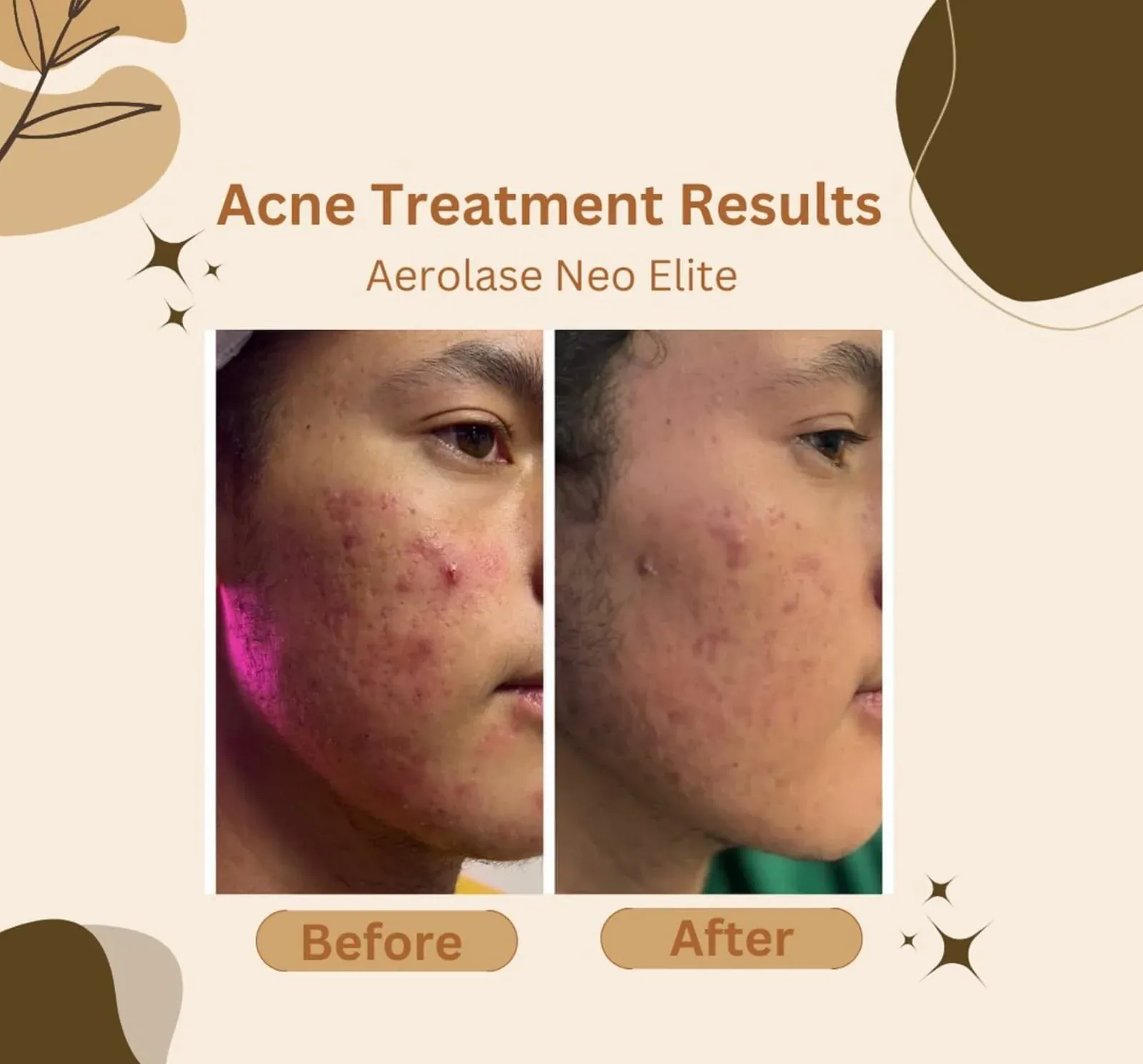 Aerolase Neo Elite laser treatment device