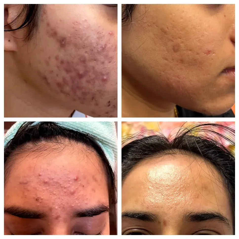 Acne laser treatment before and after in Clifton NJ