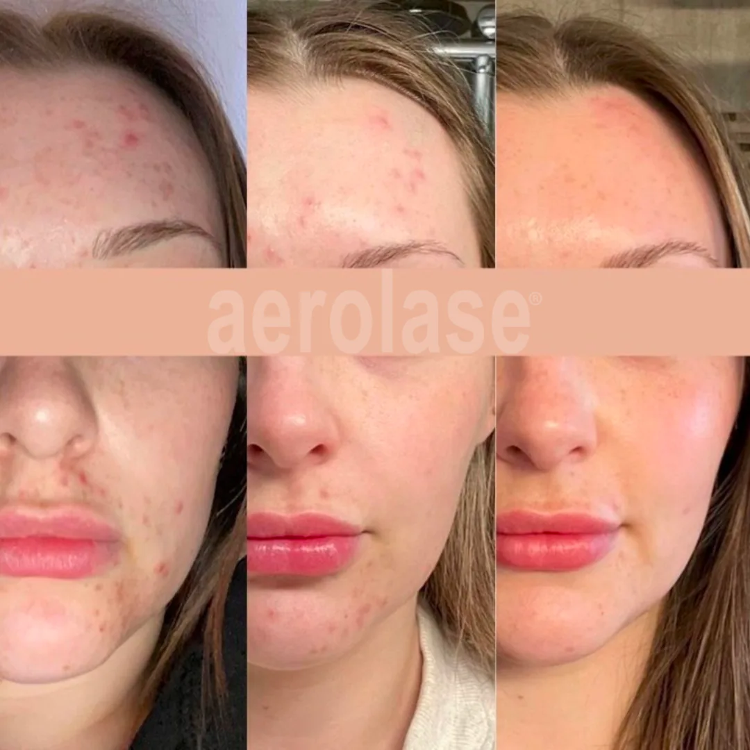 Laser skin treatment progression over 6 sessions