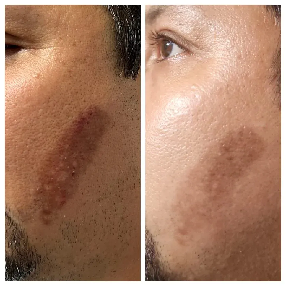 Laser pigmentation treatment results Clifton NJ