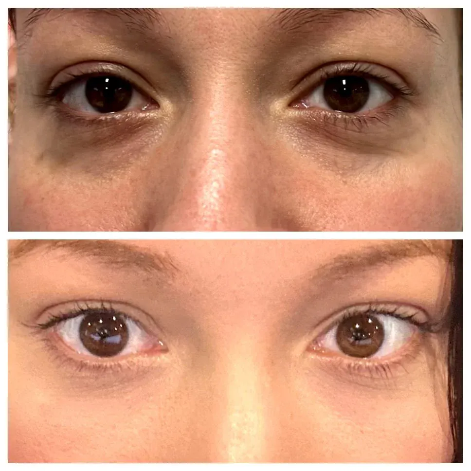 Under eye treatment for dark circles and puffiness